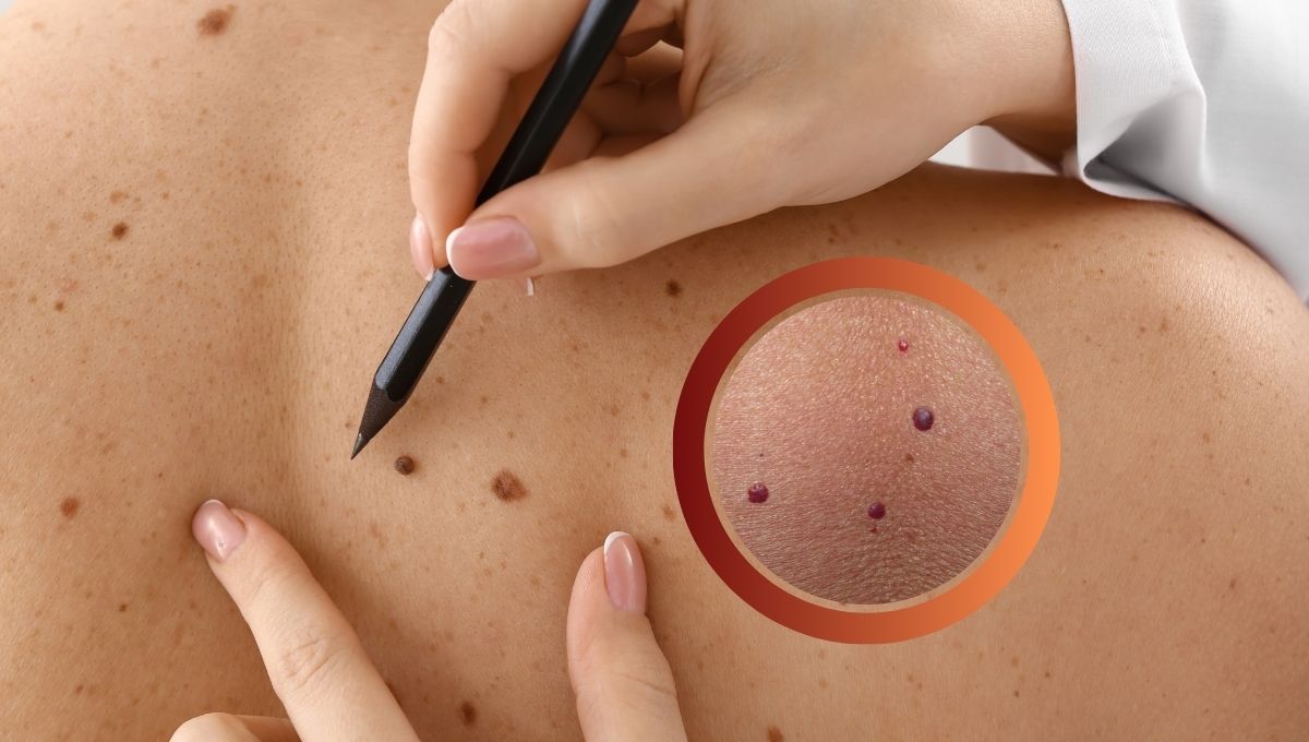 Lunares rojos: Por qué aparecen en la piel y qué significado tienen