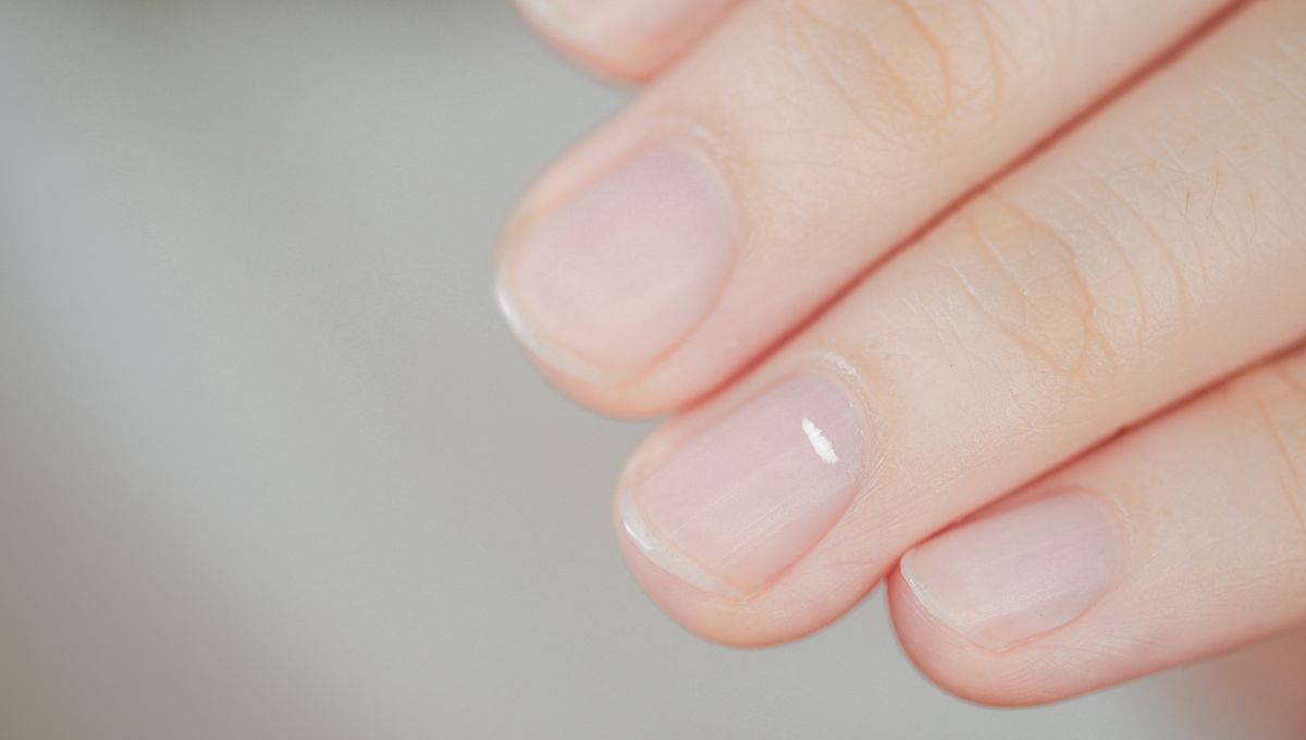 Las manchas blancas en las uñas desaparecen con el tiempo. Las manchas blancas en las uñas desaparecen con el tiempo.