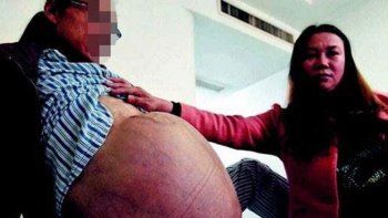 Médicos chinos extirpan un tumor de 31 kilos, uno de los mayores del mundo