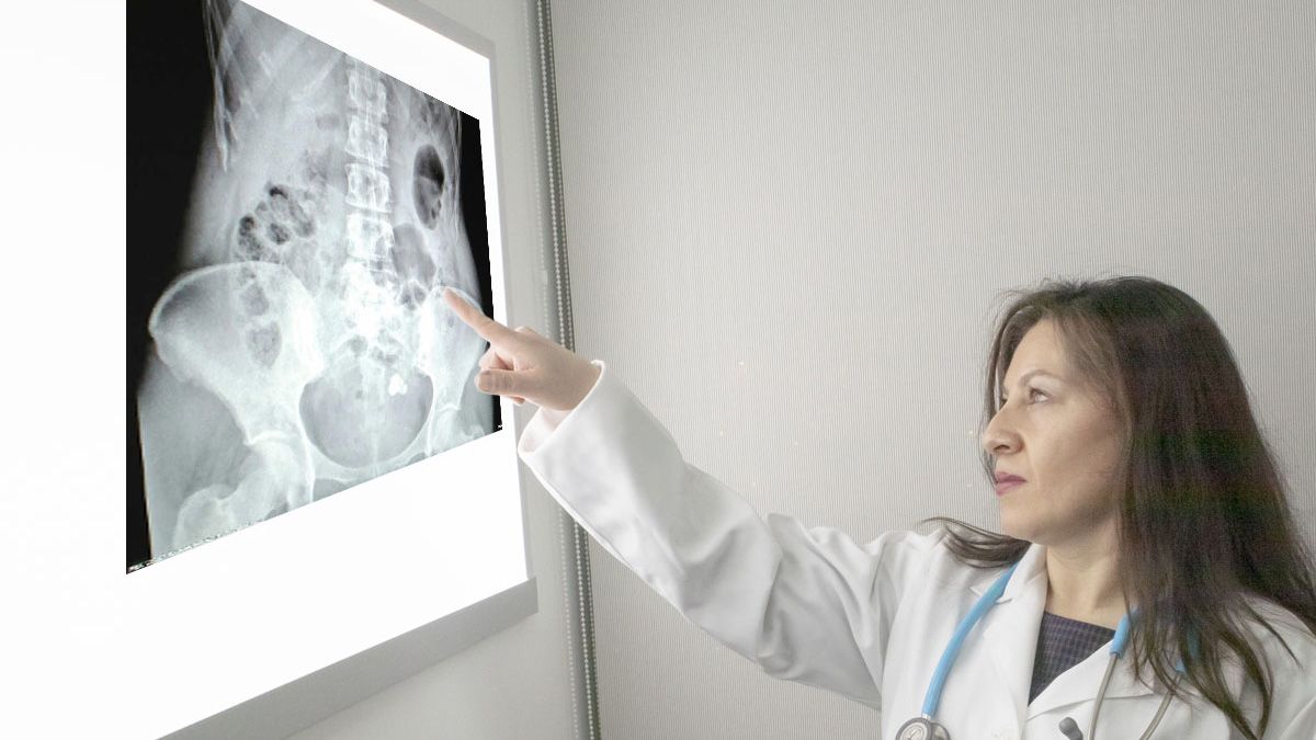 El cáncer de ovario es el séptimo más frecuente en las mujeres de Argentina El cáncer de ovario es el séptimo más frecuente en las mujeres de Argentina