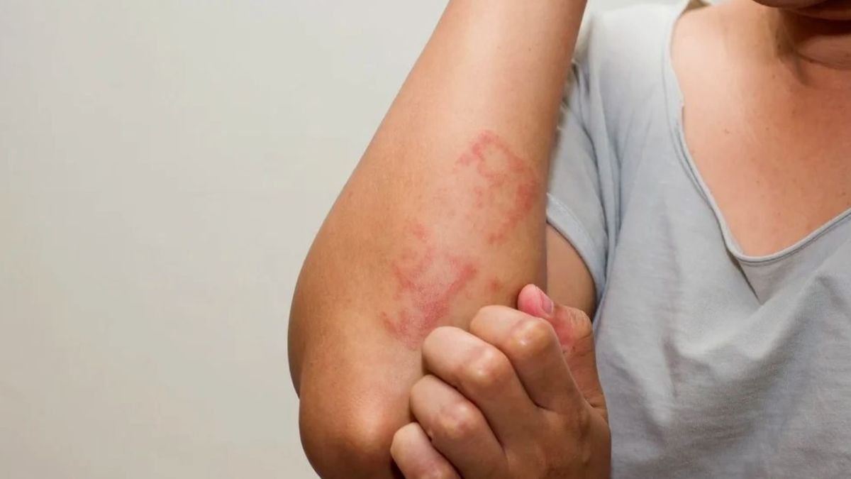 Urticaria crónica: una fuerte picazón y un impacto profundo en la calidad de vida