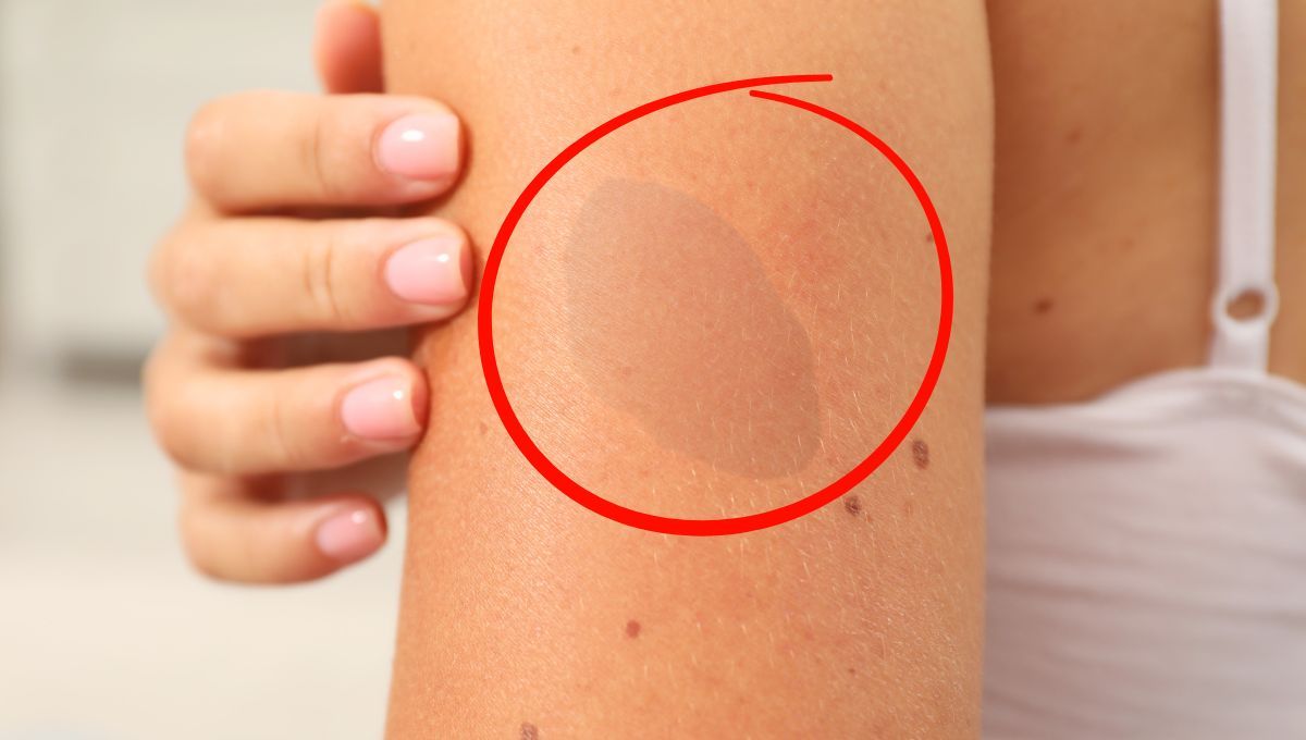 Qué significa tener una mancha de nacimiento en el brazo