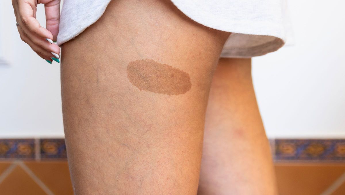 Se cree que las manchas de nacimiento son pruebas de nuestras vidas pasadas, ofreciendo pistas sobre cómo morimos en ellas. Se cree que las manchas de nacimiento son pruebas de nuestras vidas pasadas, ofreciendo pistas sobre cómo morimos en ellas.