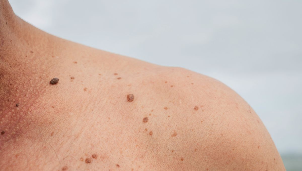 Qué significa tener lunares en el cuerpo