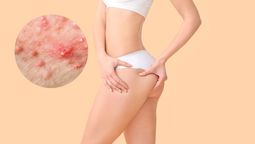 Por qué aparecen los granos en los glúteos y en las piernas: cómo evitarlos