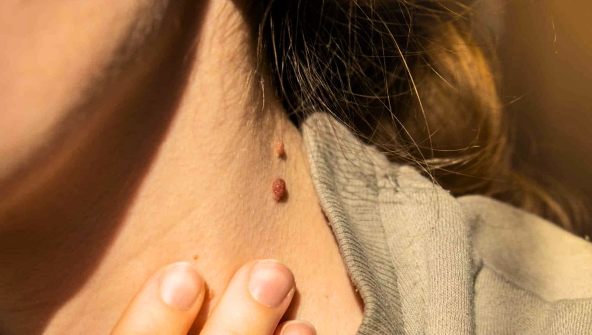 Las verrugas pequeñas pueden ser eliminadas gracias a un sencillo truco casero