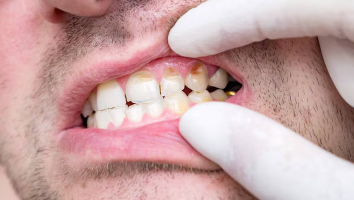 Cómo eliminar el sarro de los dientes tomando té