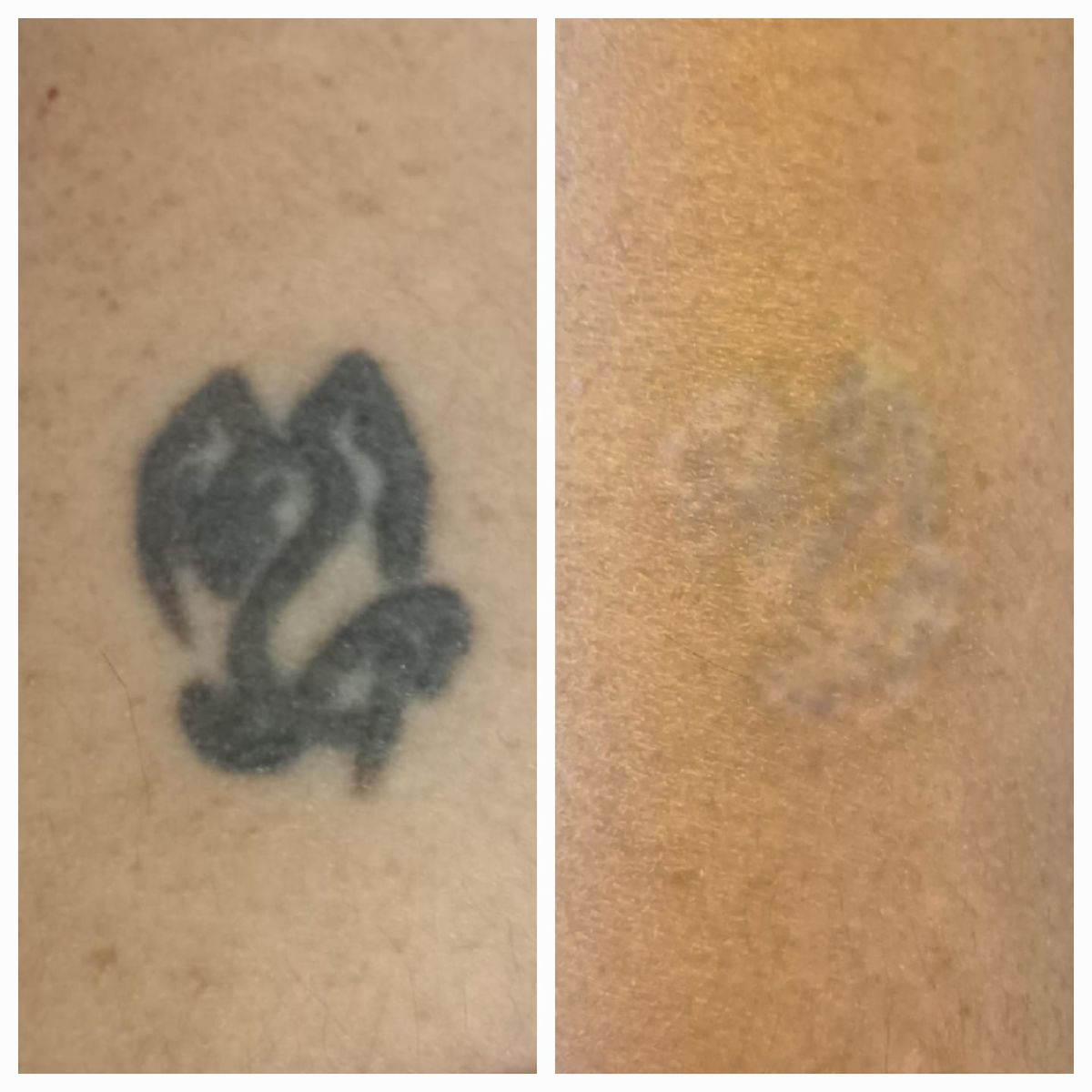 Resultados de un tatuaje borrado. Resultados de un tatuaje borrado.