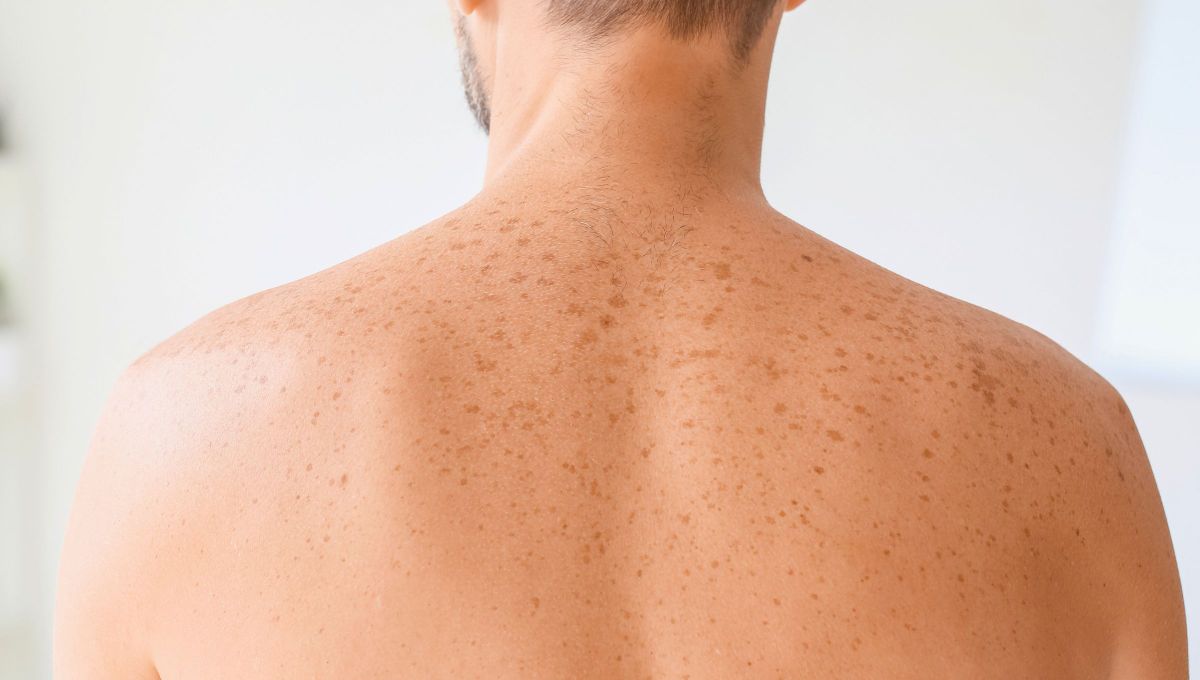 ¿Qué significa que una persona tenga pecas en la espalda?