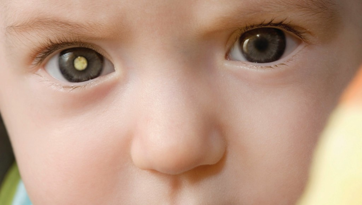 Día internacional de la enfermedad de Coats: ¿en qué consiste esta dolencia?