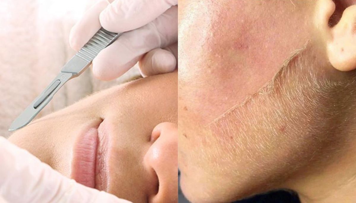 El dermaplaning elimina c&eacute;lulas muertas de la piel y el vello fino del rostro.