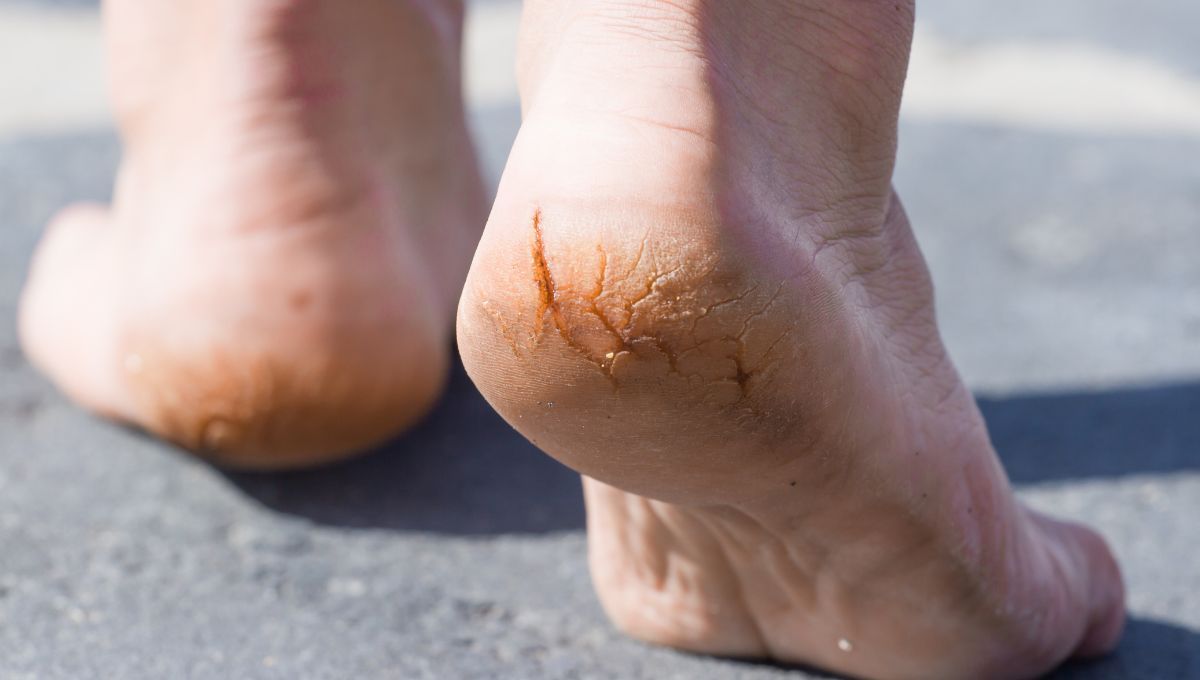 Decile chau a los talones rajados y agrietados con esta crema casero