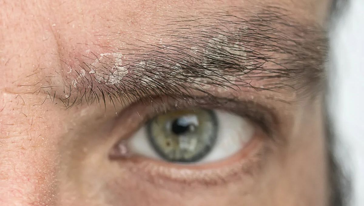 Caspa en la cara. Caspa en la cara.