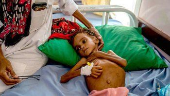 Murió Amal, la niña de la foto símbolo de la guerra en Yemen