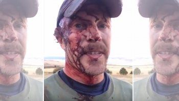 Así quedó un cazador tras ser atacado  por un oso