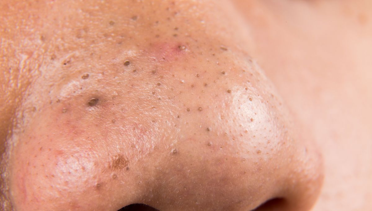 Granos en la nariz. Granos en la nariz. 