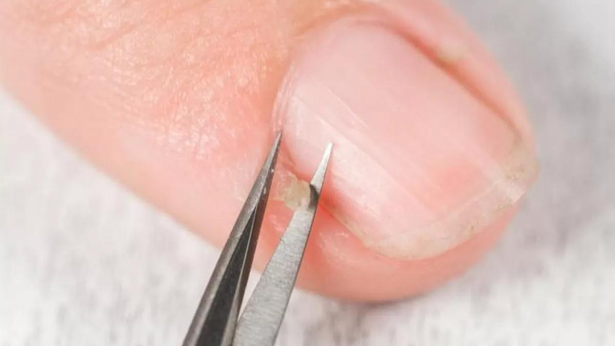 Los padrastros son pequeñas lesiones en la zona de la piel que rodea las uñas y suelen ser muy molestos. Con este sencillo truco podrás retirarlos sin lastimarte. Los padrastros son pequeñas lesiones en la zona de la piel que rodea las uñas y suelen ser muy molestos. Con este sencillo truco podrás retirarlos sin lastimarte.