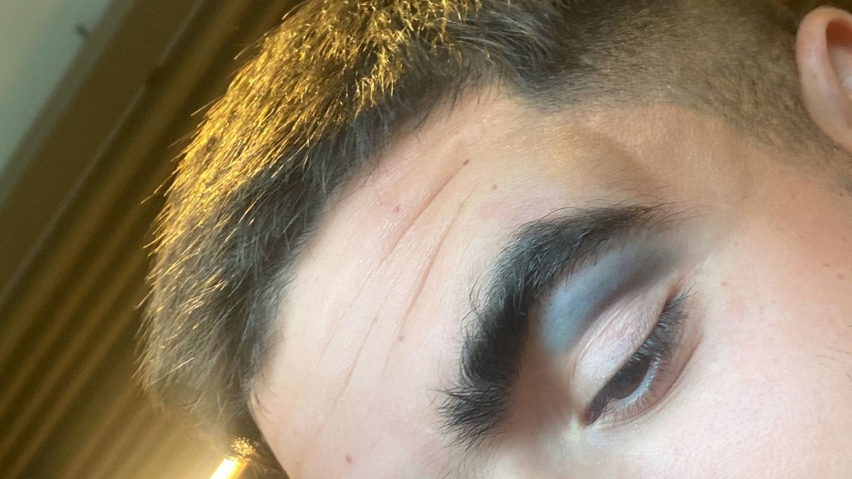 El hematoma en el ojo fue otro saldo lamentable de la agresión del hinchas del Colo Colo a un grupo de amigos tombinos. El hematoma en el ojo fue otro saldo lamentable de la agresión del hinchas del Colo Colo a un grupo de amigos tombinos.