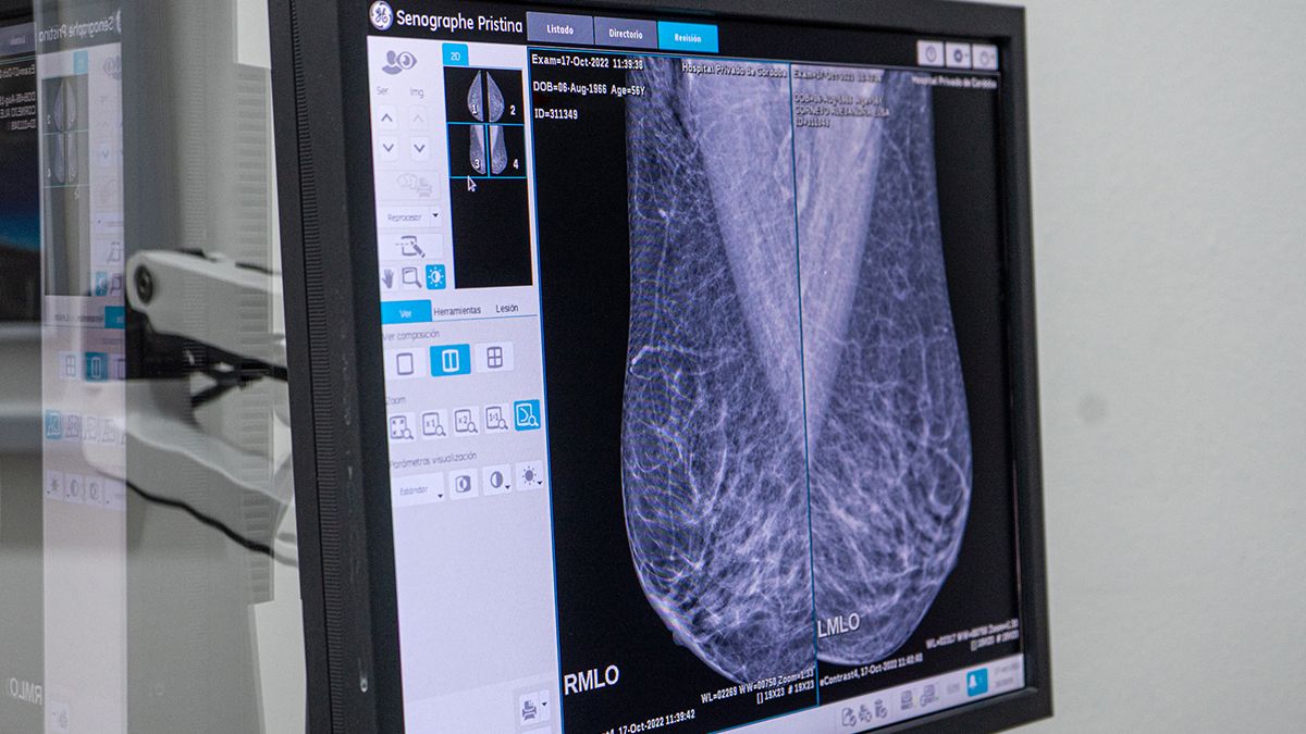 La mamografía y los controles periódicos son esenciales para la detección precoz del cáncer de mama. 