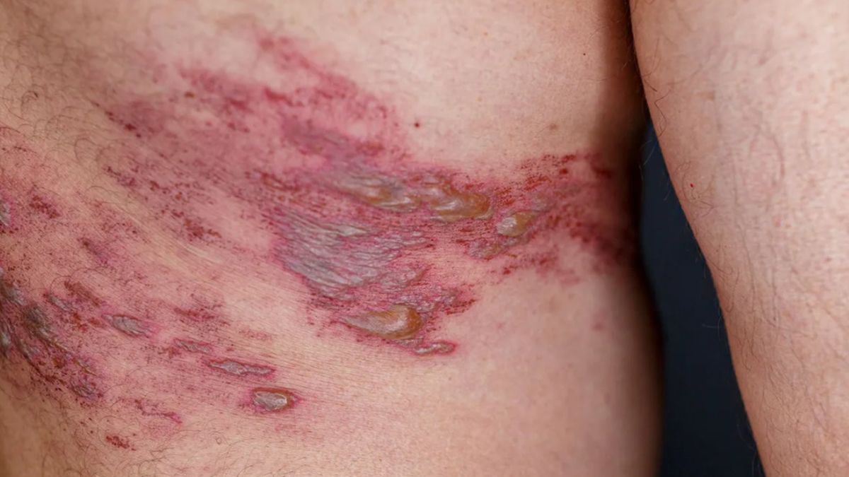 El herpes zóster o culebrilla se manifiesta como una erupción dolorosa en forma de cinturón y afecta más a adultos mayores El herpes zóster o culebrilla se manifiesta como una erupción dolorosa en forma de cinturón y afecta más a adultos mayores