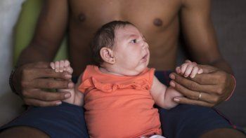 Más bebés con microcefalia en Brasil en medio de la epidemia de zika