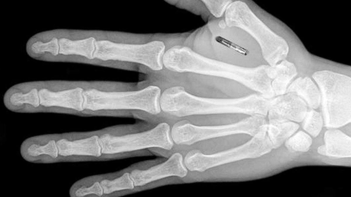 Radiografía de la ubicación del implante: entre el dedo pulgar y el índice.