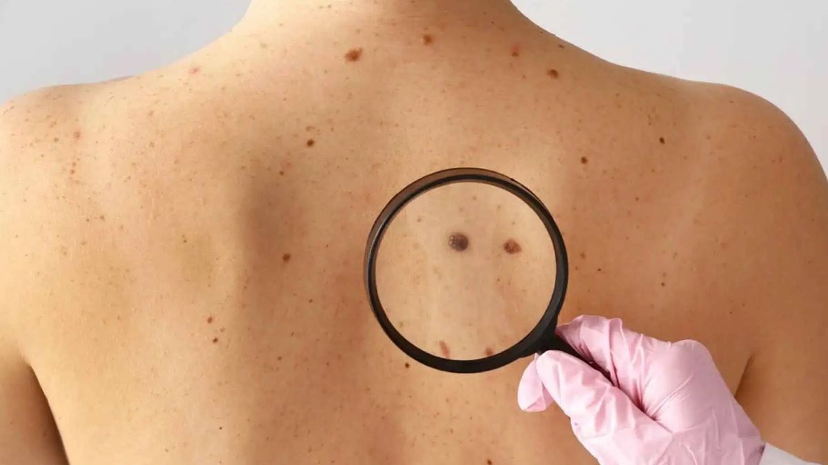 Cáncer de piel: cuál es el síntoma clave que nadie reconoce y puede salvar tu vida