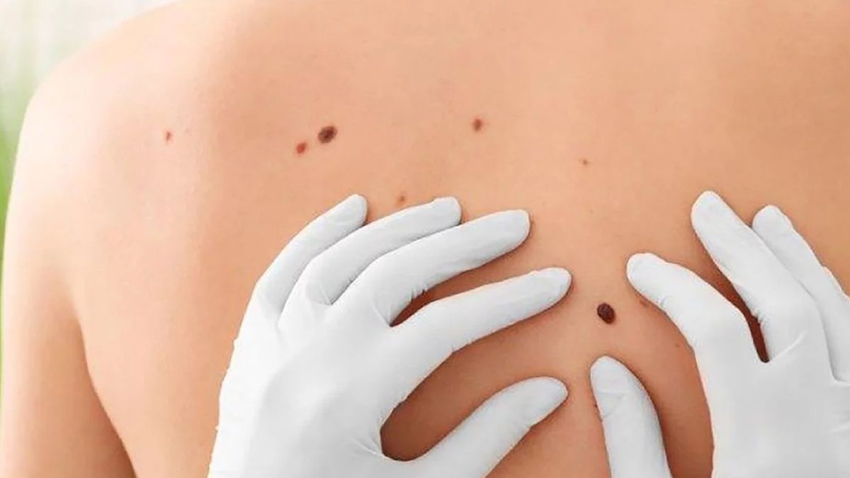Día Mundial contra el Malenoma: advirtieron sobre el aumento de su incidencia en Latinoamérica