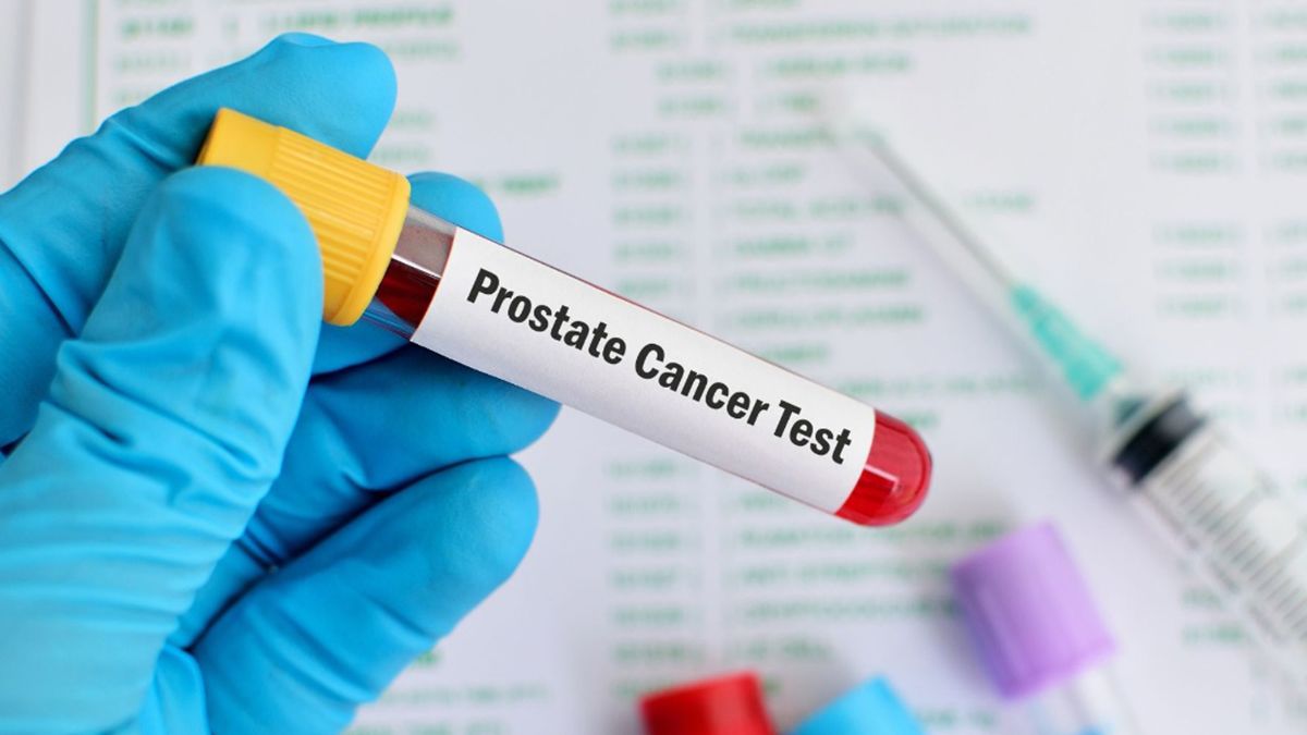 El cáncer de próstata es muy común en los hombres y el Antígeno Prostático (PSA) en un análisis que lo puede detectar. El cáncer de próstata es muy común en los hombres y el Antígeno Prostático (PSA) en un análisis que lo puede detectar.