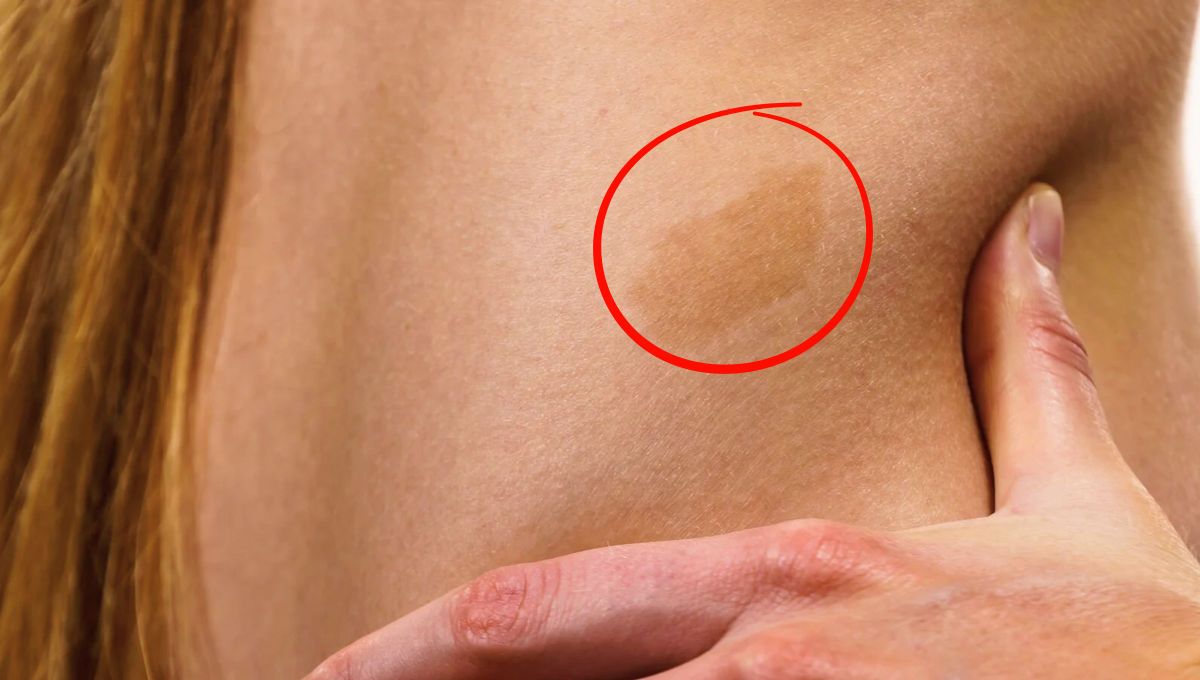Qué significa tener una mancha de nacimiento en el cuerpo