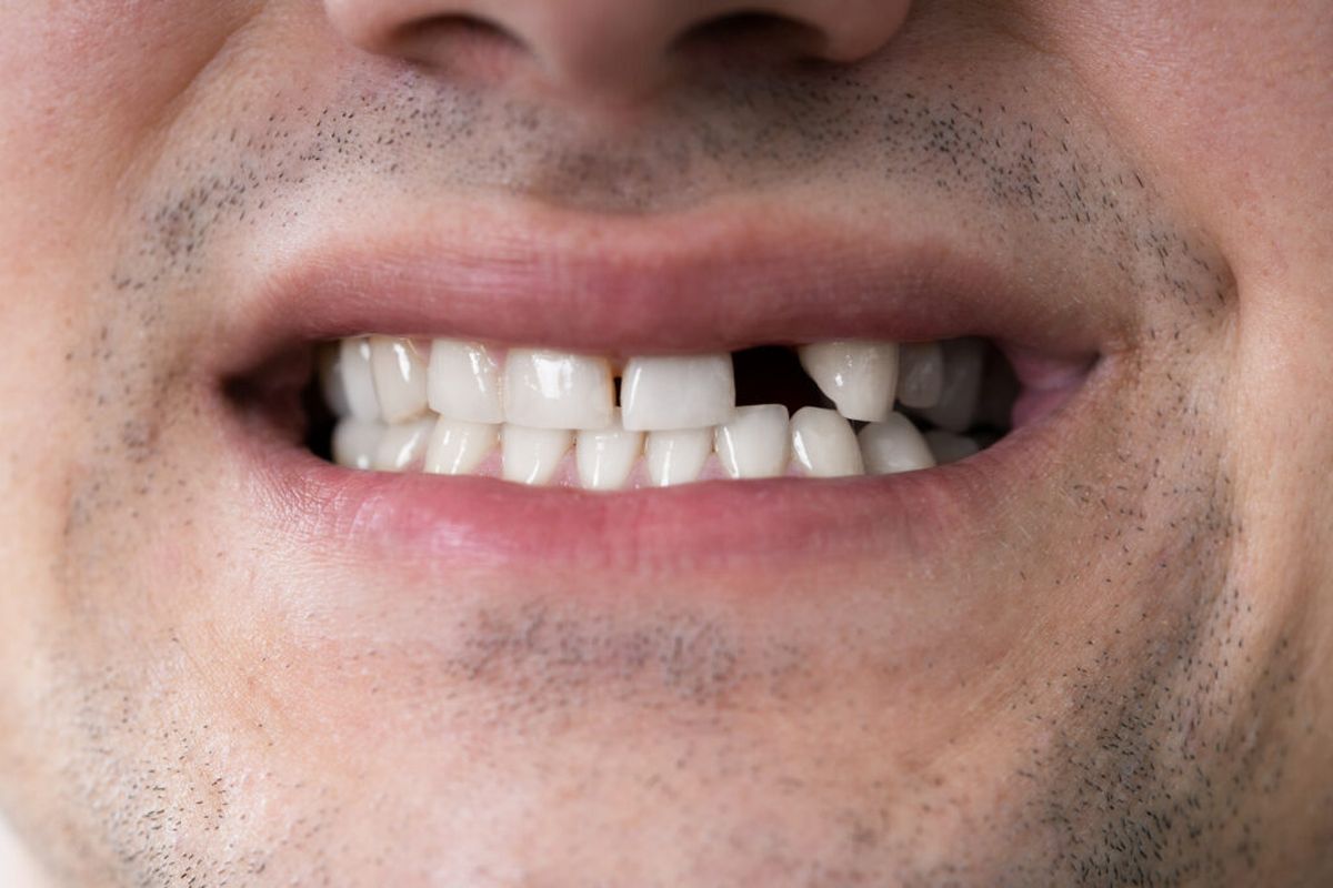 El sorprendente fármaco que es probado en humanos y podría regenerar dientes perdidos El sorprendente fármaco que es probado en humanos y podría regenerar dientes perdidos