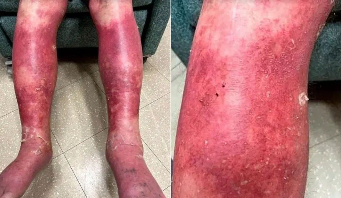 Richard Terrel, de 74 años, sufrió una reacción alérgica poco común a la vacuna contra el coronavirus Johnson & Johnson. La explicación médica