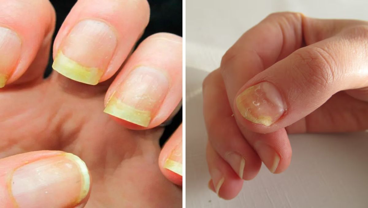 Si tienes las uñas amarillas, prueba con alguno de estos trucos para dejarlas limpias y sanas