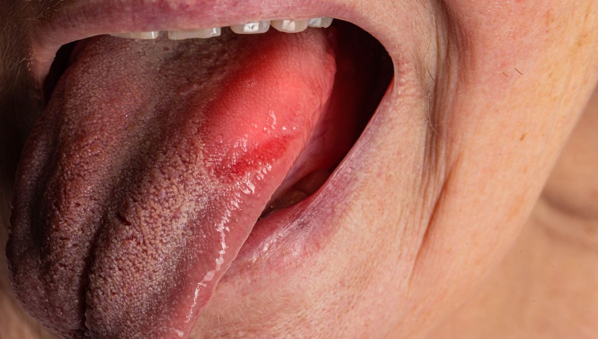 La lengua roja puede ser un signo poco conocido que provoca el covid. La lengua roja puede ser un signo poco conocido que provoca el covid.