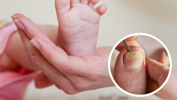 Los hongos en las uñas de los pies pueden resultar molestos y dolorosos para nuestros hijos&nbsp;
