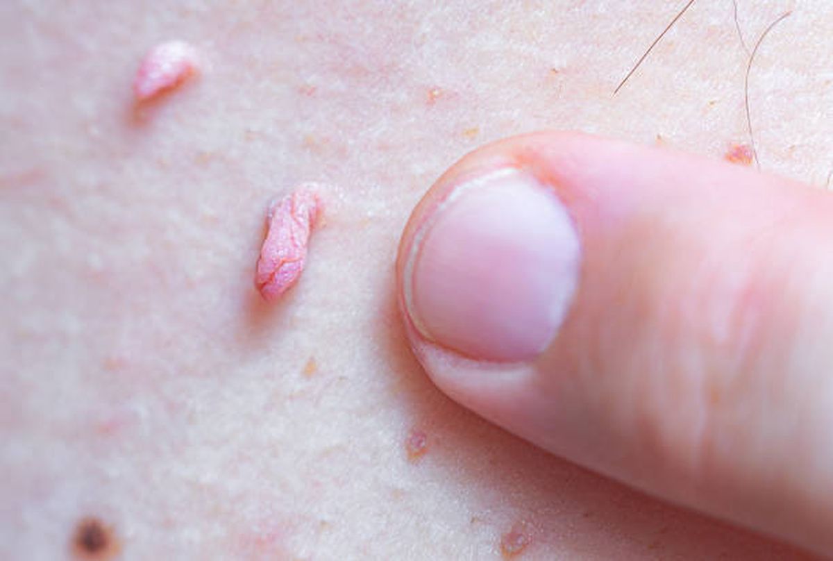 La inmunización en varones previene verrugas y tumores en el hombre, además de frenar la circulación general del virus en la sociedad. La inmunización en varones previene verrugas y tumores en el hombre, además de frenar la circulación general del virus en la sociedad.