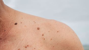 Qué significa tener lunares en el cuerpo Qué significa tener lunares en el cuerpo