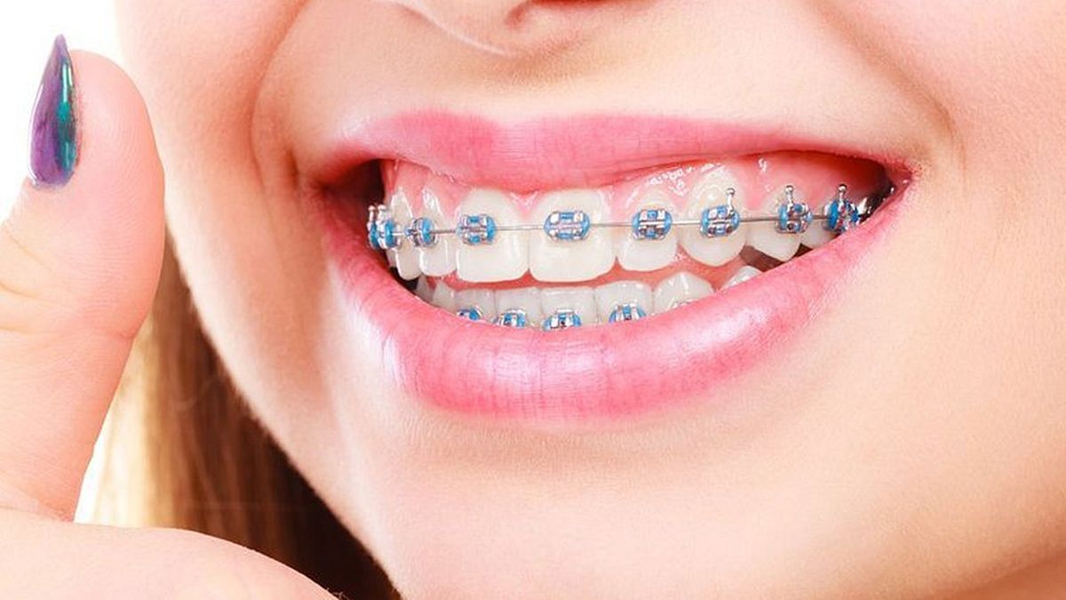 No digas brackets: existe una palabra en español que es mucho refinada y bonita