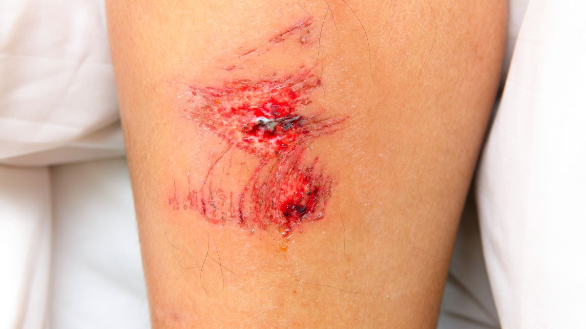 Esta planta puede servir para cicatrizar heridas de este tipo. Esta planta puede servir para cicatrizar heridas de este tipo.