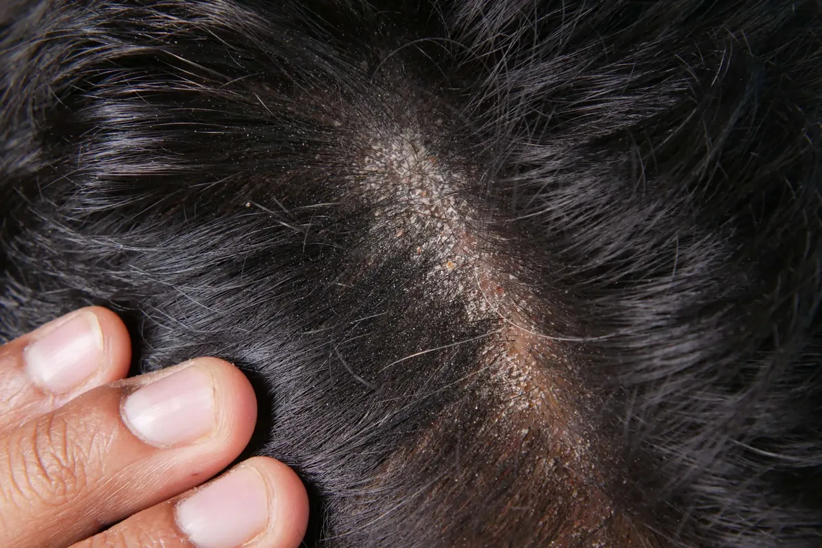 La alopecia afecta a millones de personas.