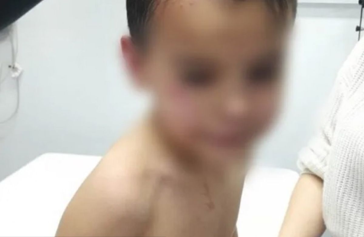 Los disparos del atacante provocaron que las esquirlas le rozaran la cara y la ceja derecha al niño, sufriendo lesiones leves Los disparos del atacante provocaron que las esquirlas le rozaran la cara y la ceja derecha al niño, sufriendo lesiones leves