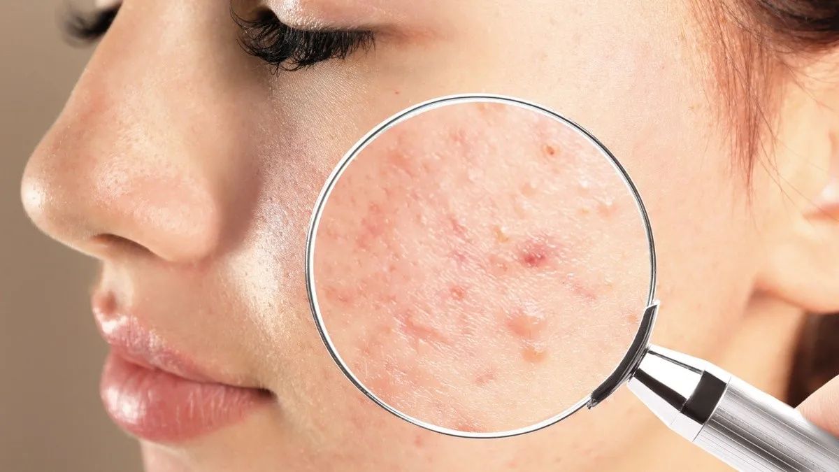 Los remedios caseros son una de las mejores formas de eliminar el acné de manera natural.