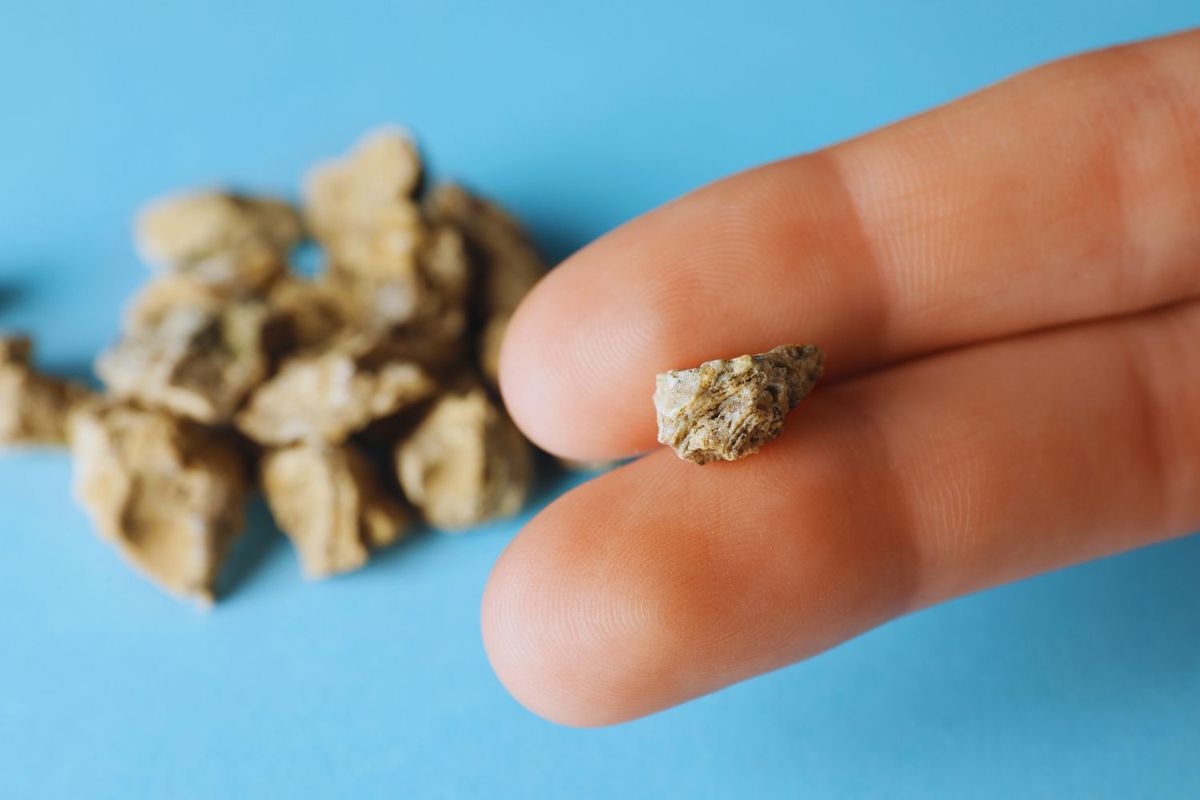 Tomaba 3 litros de Coca-Cola por día y le sacaron 35 piedras de la vejiga