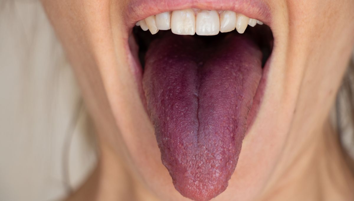 Lengua morada, signo de inflamación y momento de consultar a tu odontólogo. Lengua morada, signo de inflamación y momento de consultar a tu odontólogo.
