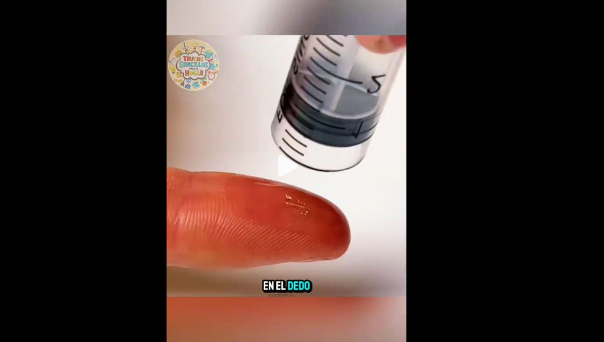 El truco para quitar una astilla solo requiere unas gotas de aceite y una jeringa. El truco para quitar una astilla solo requiere unas gotas de aceite y una jeringa.