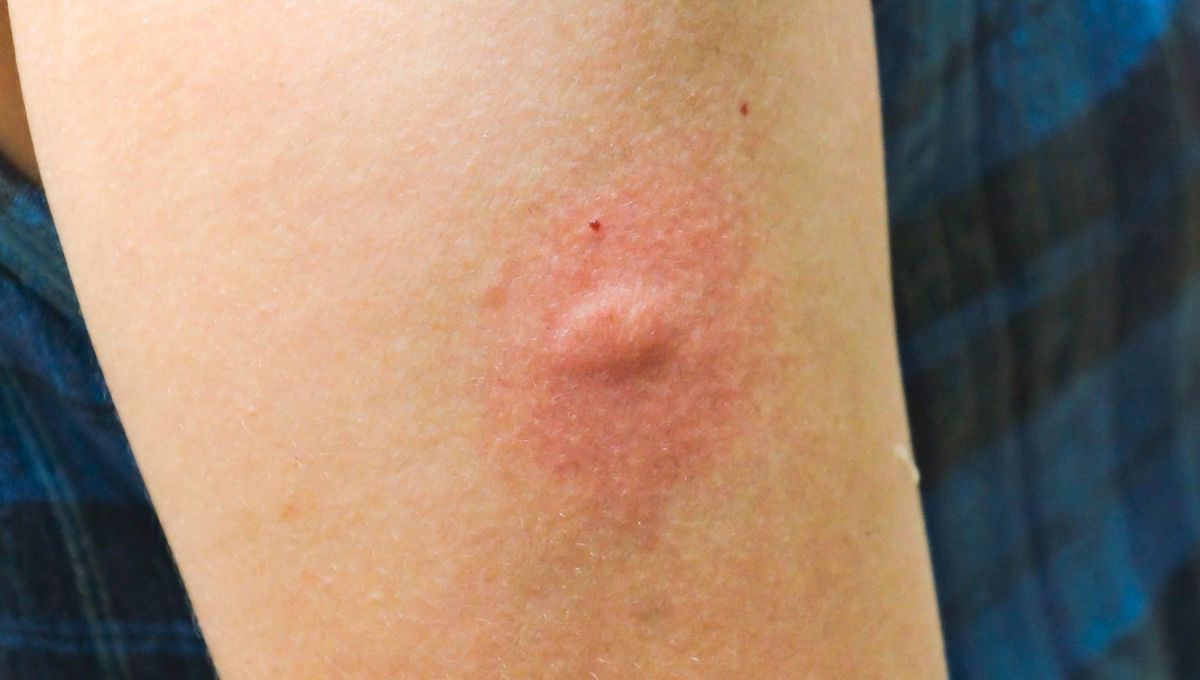 La explicación que todos esperaban: por qué los mosquitos pican a algunas personas y a otras no