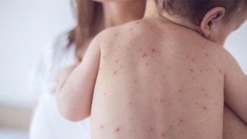 Una madre anti-vacunas pidió consejos para proteger a su hija del Sarampión