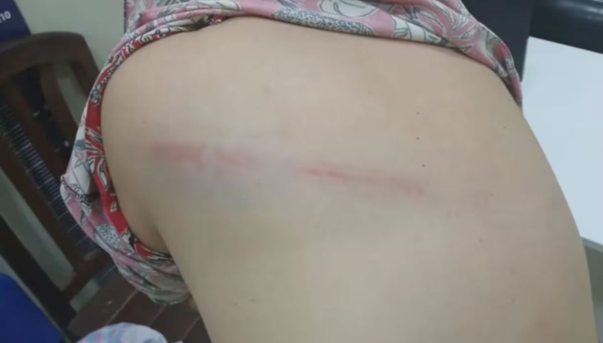 Un hombre atacó a su esposa a latigazos porque no le gustó como le cebó el mate provocándole graves lesiones. Un hombre atacó a su esposa a latigazos porque no le gustó como le cebó el mate provocándole graves lesiones.