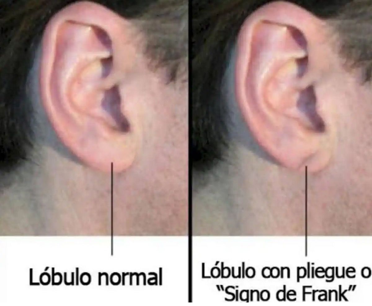 El pliegue en el lóbulo de la oreja (PDE) puede indicar una posible enfermedad cardiovascular. El pliegue en el lóbulo de la oreja (PDE) puede indicar una posible enfermedad cardiovascular.