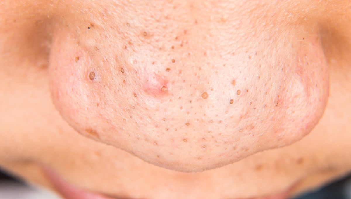 Acné en la nariz. Acné en la nariz. 